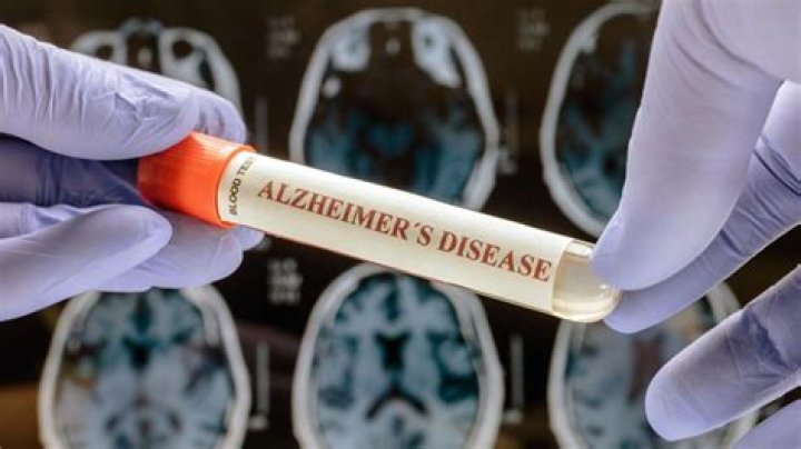 Alzheimer’s blood test could be used to screen even before symptoms: study