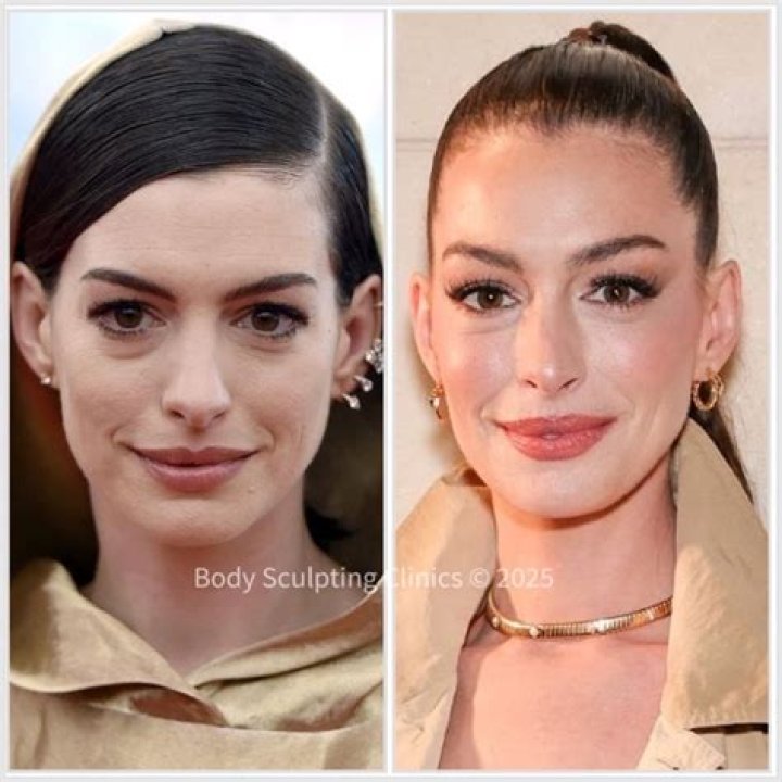 Anne Hathaway Chirurgie : Les éventuelles procédures cosmétiques de l'actrice
