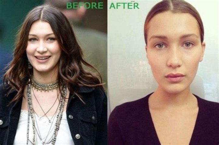 Bella Hadid Chirurgie : La mannequin américaine a-t-elle eu recours à la chirurgie esthétique ?