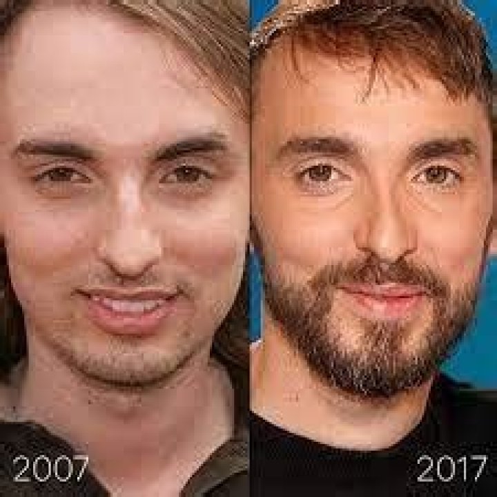 Christophe Willem Chirurgie Esthétique: 