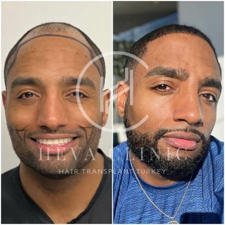 Fans Call Timbaland ‘Brave’ After He Shows Off the Results of His Hair Transplant Procedure