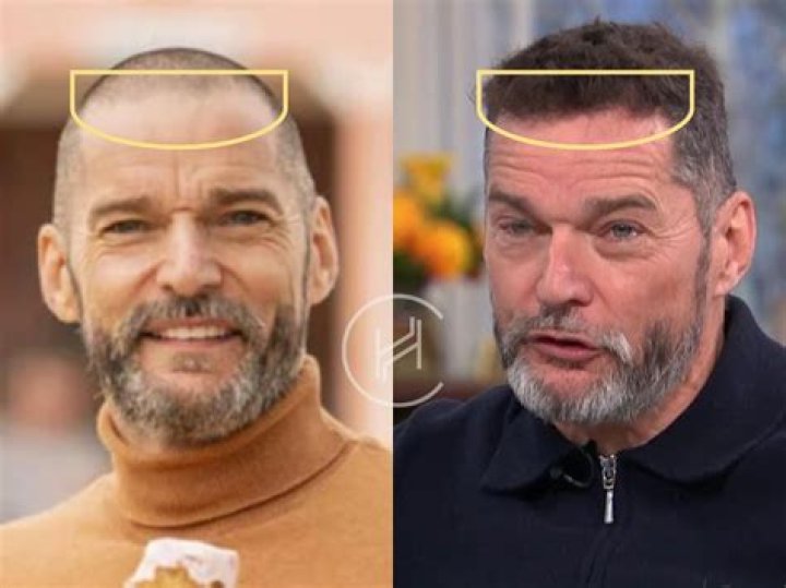 Has Fred Sirieix had a hair transplant?