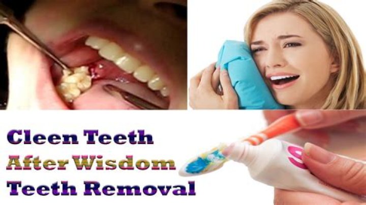 How to Clean Your Teeth After Wisdom Teeth Removal