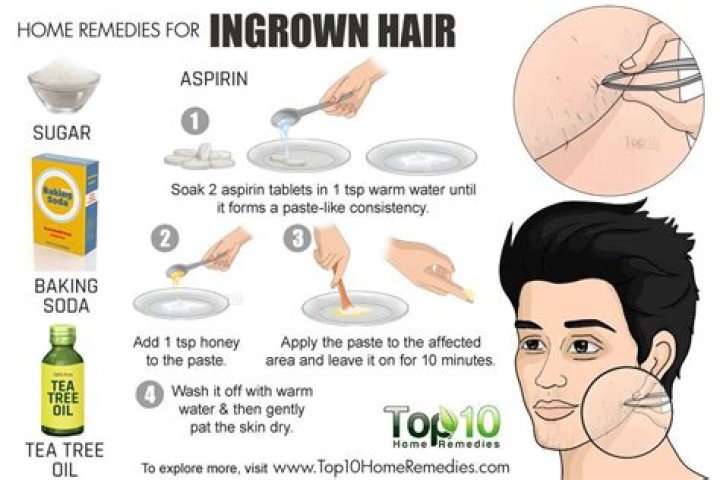 How To Deal With Ingrown Hairs