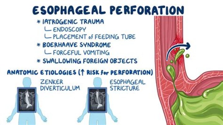 How to diagnose esophageal diverticulum