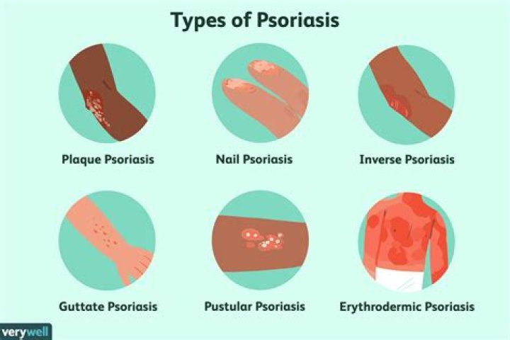 How to get rid of psoriasis