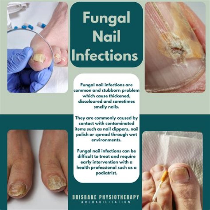 How to Treat a Fungal Infection of the Sinus Cavity