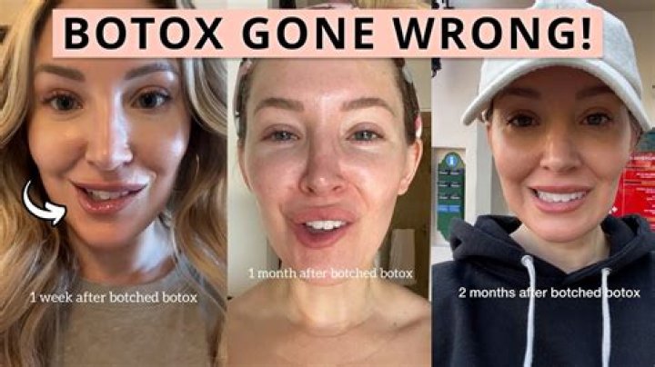 I got Botox to fix my chin dimples and now I talk with a lisp and my whole face is crooked