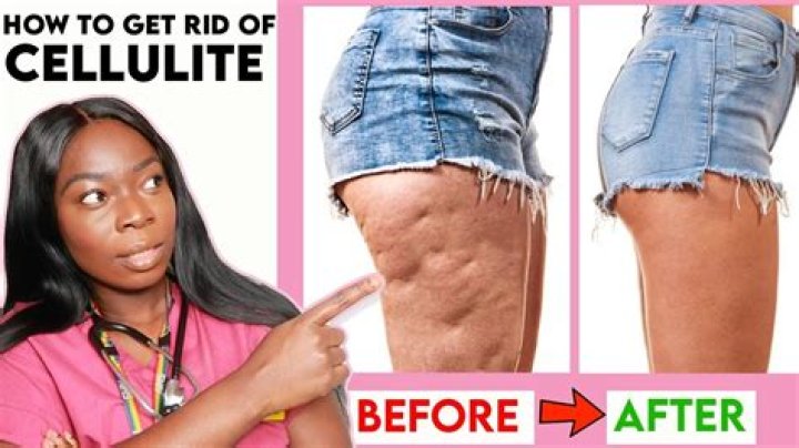 I’m slim but still have cellulite - trolls say my body ‘isn’t healthy’ but I won’t stop wearing bikinis