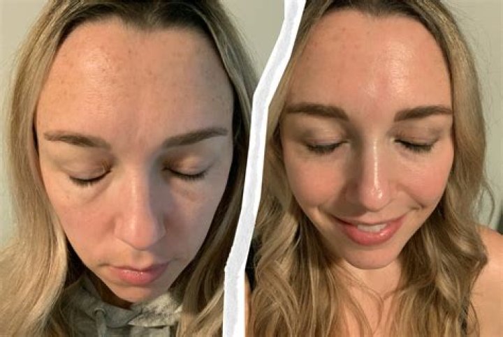 I Tried The Celeb-Beloved Treatment