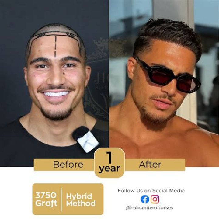 I was so self-conscious of my balding 'Mohican' I spent £2.5k on a hair transplant in Turkey, it's changed my life
