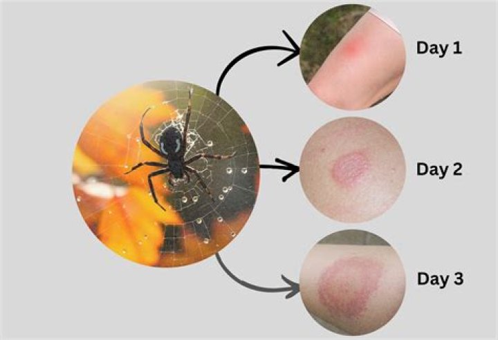 Infected spider bites torment Callie on Alone as contestant taps out