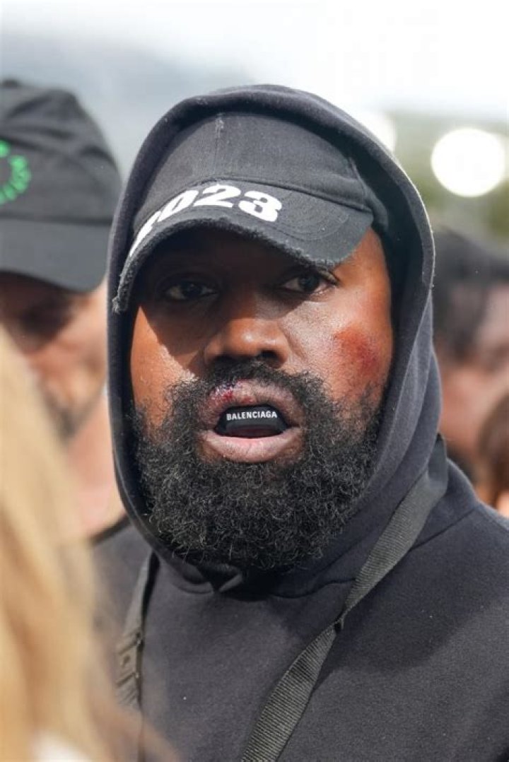 Kanye West shocks fans with bloody lip and bruises as he wears mouth guard at fashion week