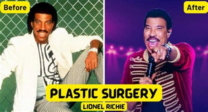 Lionel Richie and plastic surgery