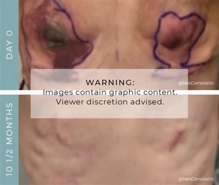 Medical tattooing can change post-mastectomy life – WHBF – OurQuadCities.com