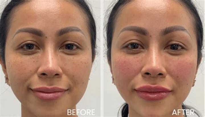 Newcastle model Beth Cowan ‘scarred for life with distorted and lumpy mouth after botched lip fillers’ – The Sun