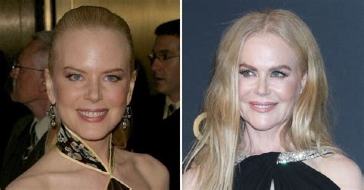 Nicole Kidman Cosmetic Surgery: The Truth Behind Her Transformation