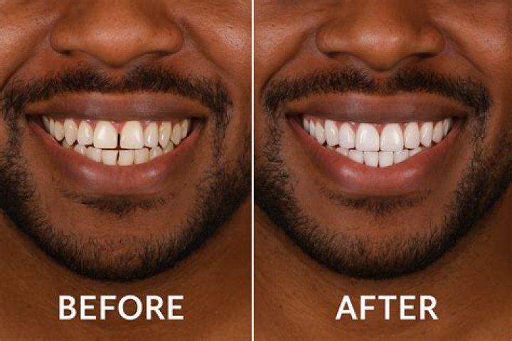 What are clip-on veneers, how long do they last, how much do they cost and can you eat with them?