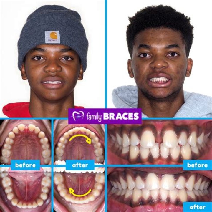 What Happened To Jalen Green Teeth? Before And After – Did She Used Braces or Whitening?