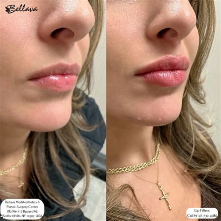 What is the longest lasting lip filler 2022?